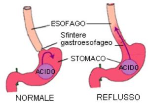 REFLUSSO GASTROESOFAGEO SINTOMI CAUSE E RIMEDI NATURALI Erbario Della Salute